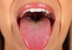舌头溃疡怎么办最快愈合