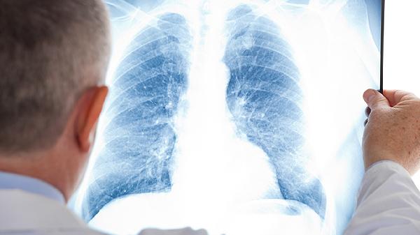 75岁老人患有肺纤维化能活多久