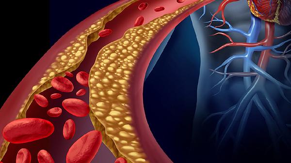 粥状动脉硬化早期症状和治疗方法