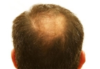 秃头还能长出头发吗
