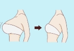 巨乳缩小手术有副作用吗