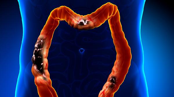 如何才能清理肠道宿便呢