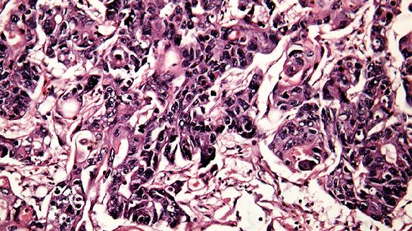 病毒性感染引起咳嗽吃什么药