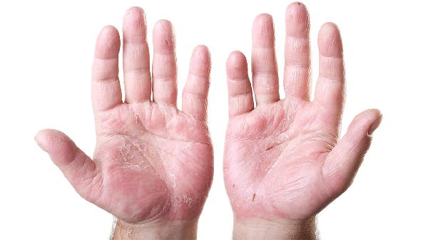 打流脑疫苗后手掌发白