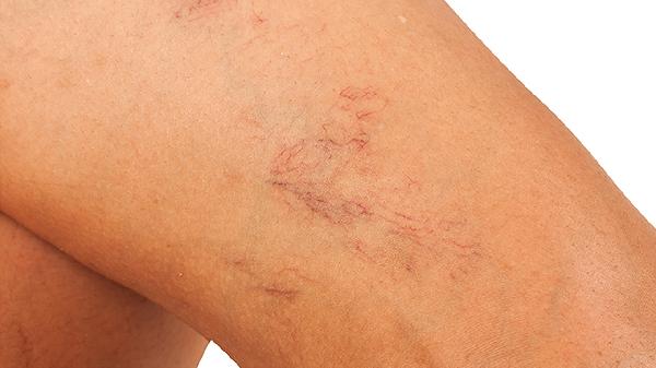 先天脑血管畸形的症状有哪些