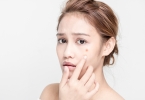 痘印怎么去除最有效的方法 中医去痘印的3大高效方案