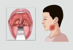 扁桃体发炎快速恢复的方法