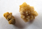 双肾泥沙结石严重吗
