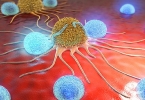 怎样缓解神经性偏头疼