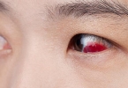 红眼病能治疗吗