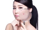 长痤疮的主要原因是什么