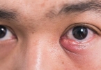 霰粒肿怎么自然排脓