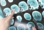 什么是脑血栓的前兆有哪些