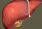 胆囊性腹膜炎有哪些表现
