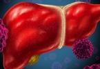 肝炎腹水可以吃大蒜吗
