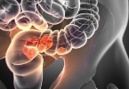 直肠癌可以吃茭白吗