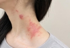 婴儿脂溢性皮炎怎么治疗呢
