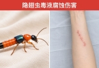被隐翅虫伤到涂牙膏？这3个做法都错了